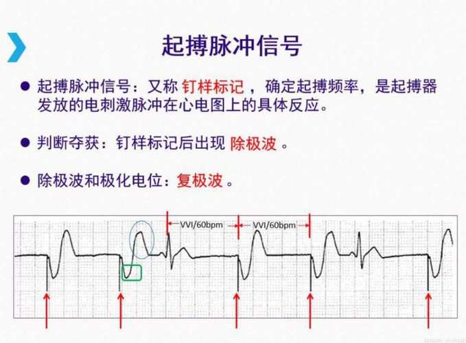 心臟起搏器電路原理如圖 心臟起搏器電路原理如圖